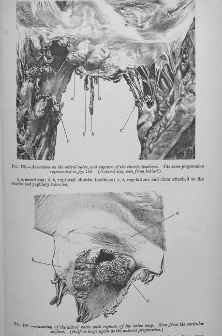 Иллюстрации Бирома Брамвелла пораженных клапанов при эндокардите, 1884 г.