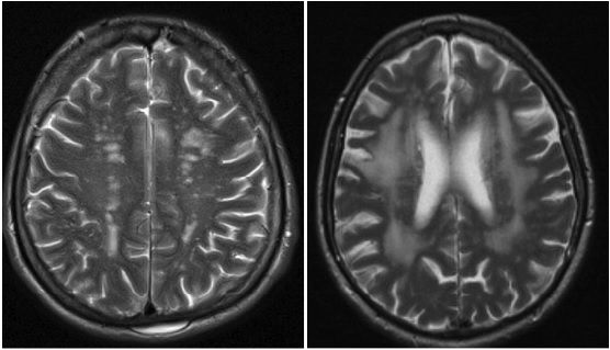 КТВР: Множественные сосудистые очаги (слева) и лейкоареоз (справа) у пациента с СД 2 типа (по данным МРТ головного мозга)