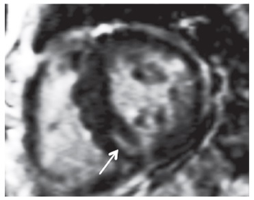 Гипертрофия миокарда на МРТ сердца у пациентки с болезнью Фабри.