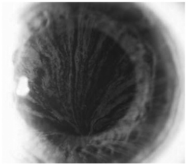 Воронковидная кератопатия (cornea verticillata) при болезни Фабри