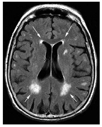 МРТ головного мозга пациента с ДЭ и жалобами на головокружение: диффузное двустороннее изменение белого вещества полушарий головного мозга – перивентрикулярный лейкоареоз