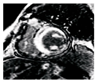 Симметричное утолщение стенки сердца и накопление гадолиния в субэндокарде при МРТ у пациента с ATTRамилоидозом