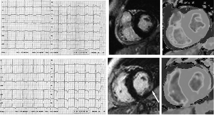 Данные ЭКГ и МРТ сердца у 59-летней женщины с классической формой болезни Фабри (вверху - исходно, внизу - через 2 года) [10].