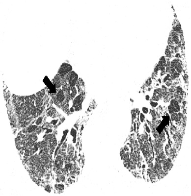 КТ-картина, не соответствующая ОИП, у пациентки 61 года с хроническим экзогенным  аллергическим аль веолитом.