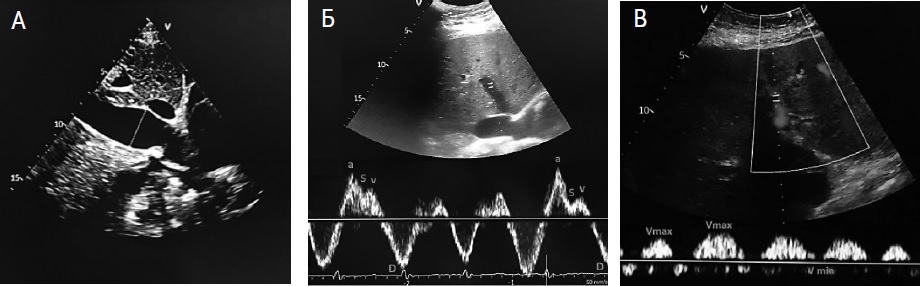 VExUS при -. А – диаметр нижней полой вены 2,8 см. Б – допплерография печеночной вены (реверсия S-волны). В – допплерография портальной вены (PI=100%).